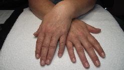 Before application of coloured tips and gel